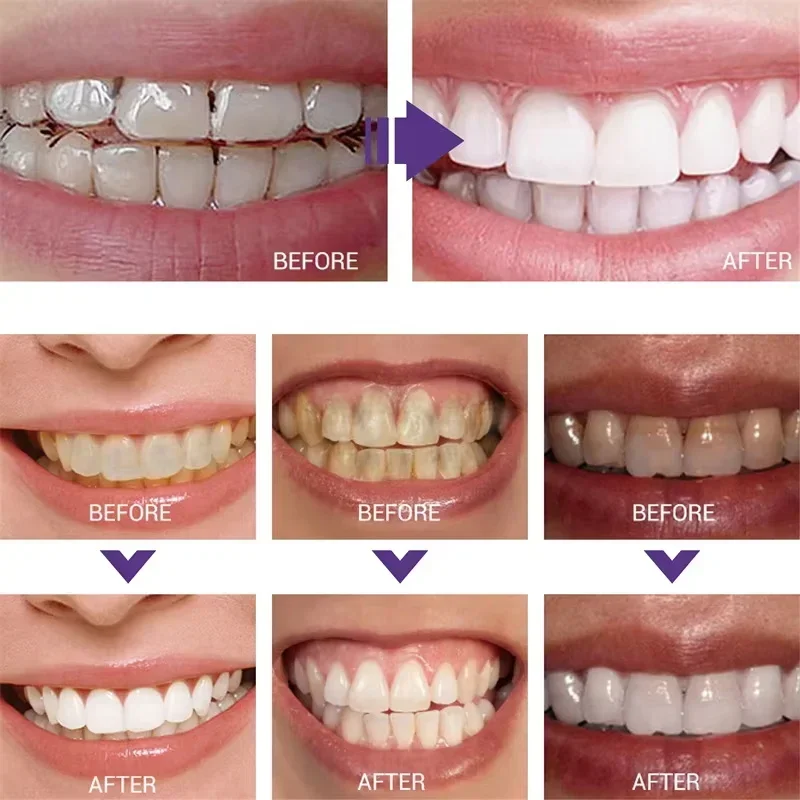 치아 세정 미백 치약 화이트닝 젤 미백제 얼룩 제거 상 - Teeth Whitening In Korea 리뷰 및 가격