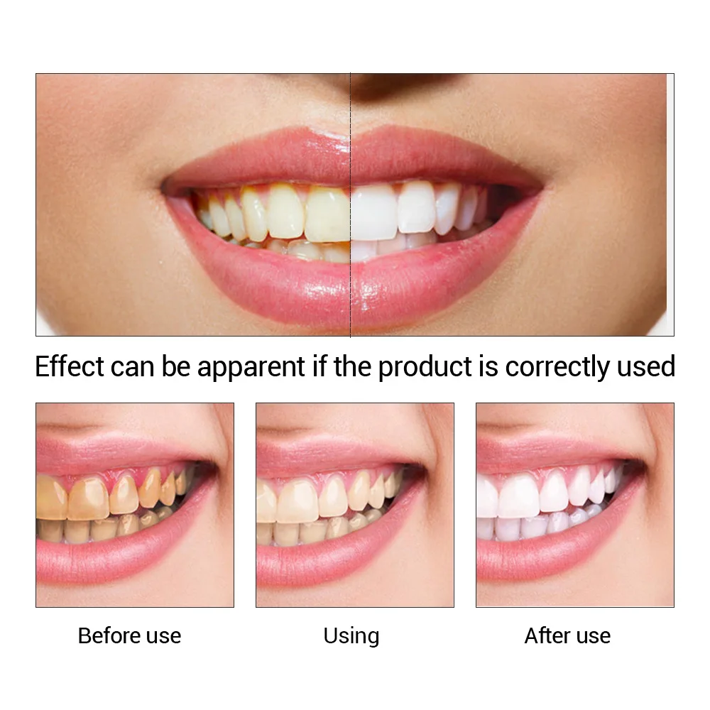 FTEENPLY 치아 미백 에센스 파우더 구강 위생 청 - Teeth Whitening (Bleaching) 리뷰 및 가격