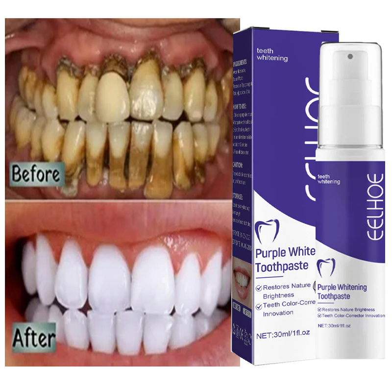 치아 클렌징 미백 치약, 미백 젤 표백제, 얼룩 제거, - Teeth Whitening In Korea 리뷰 및 가격