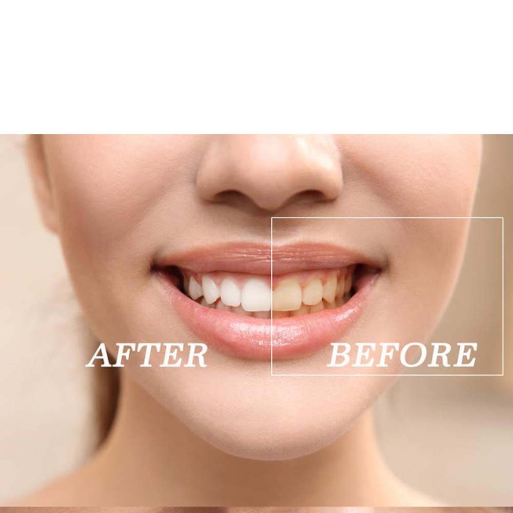 최고 품질의 과산화물 치아 미백 젤 키트 표백 시스템  - Teeth Whitening (Bleaching) 리뷰 및 가격