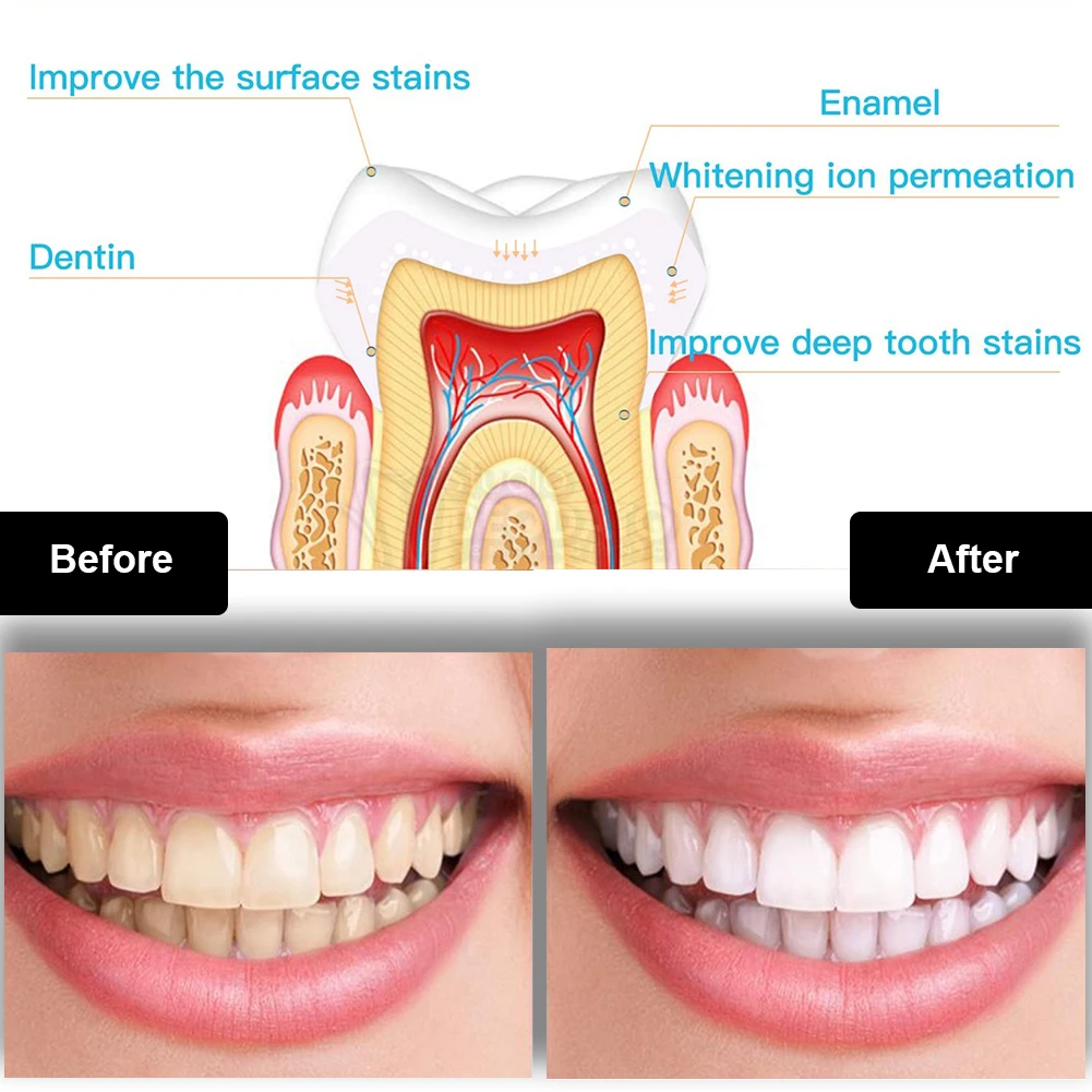 치과 치아 미백 키트 미니 16 LED 콜드 라이트 3 - Teeth Whitening Pens 리뷰 및 가격